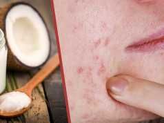 Whip Up This Potent Zit-Zapper Salve For Quick Relief