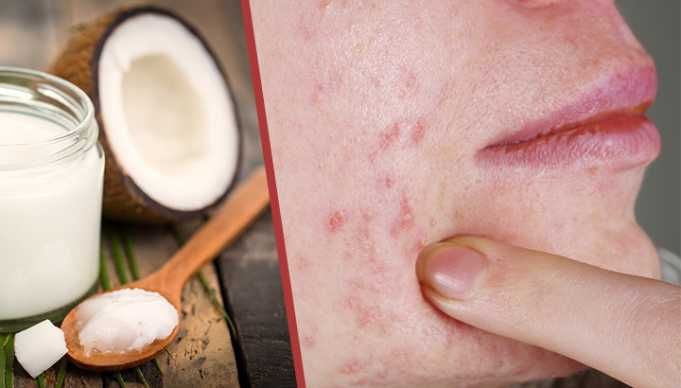 Whip Up This Potent Zit-Zapper Salve For Quick Relief