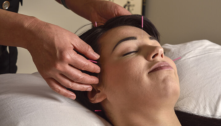 Acupuncture can help alleviate headaches.