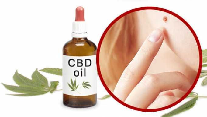 Can CBD Oil Get Rid Of Moles On Your Skin?