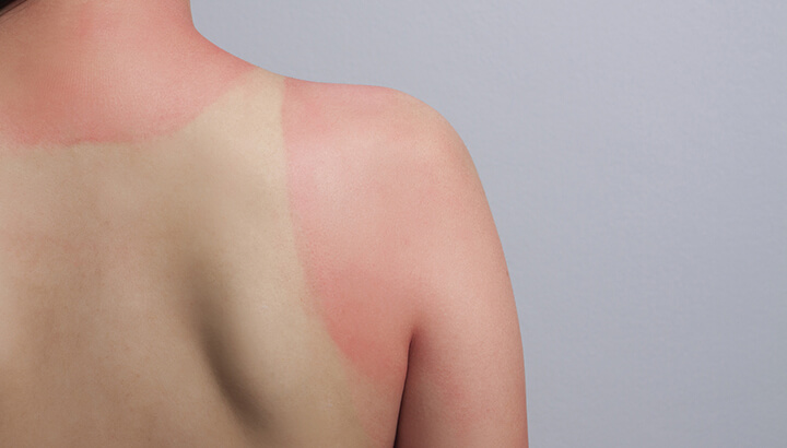 Lavender oil can soothe a sunburn.