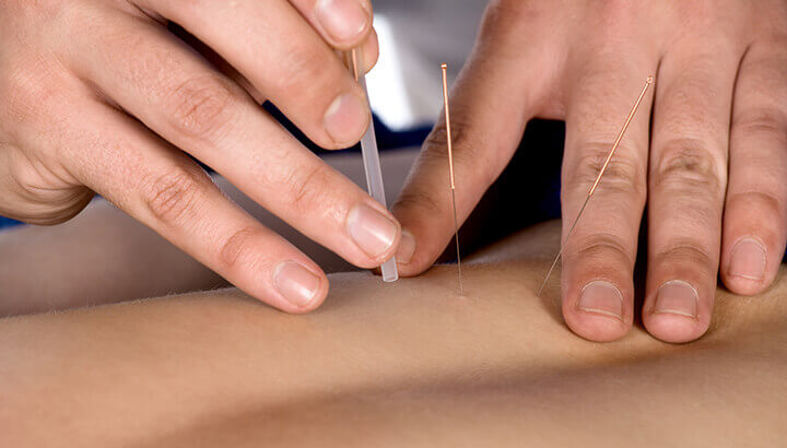 Researchers have found that acupuncture can improve symptoms of impotence.