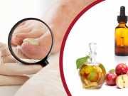 7 Natural Remedies For Toenail Fungus
