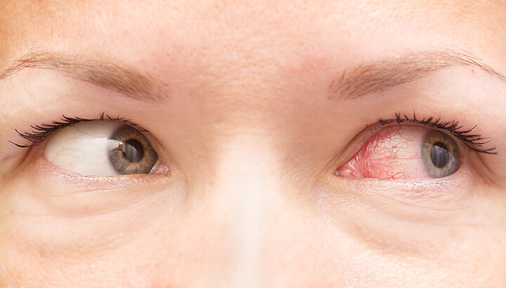 In the majority of cases, pink eye will go away on its own.