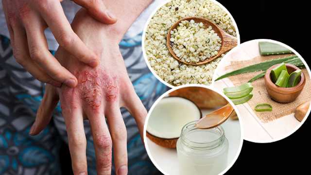 Natural remedies to treat eczema