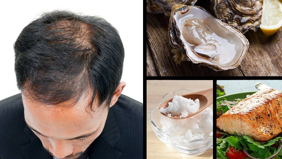 Eating THIS Could Prevent Male Baldness