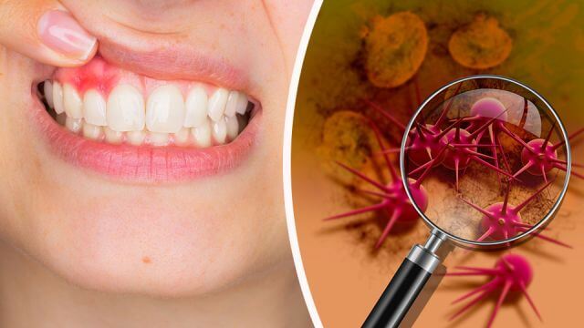 How to tell if you have mouth inflammation