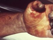 The Plague Is Here, With 124 Dead. Are Americans At Risk?