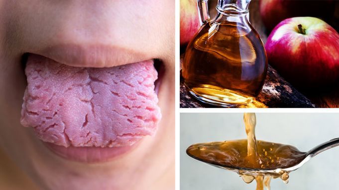 ACV + 4 Other Super Effective Candida Remedies