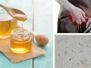 Would You Put Honey In Your Vagina For A Yeast Infection?