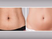 7 Ways To Tighten Flabby Skin After Weight Loss