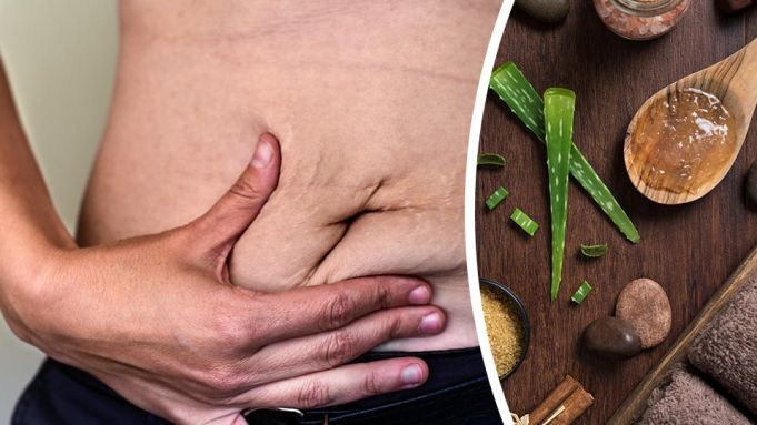 5 Natural Stretch Mark Remedies You’ve Never Heard About