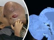 Teenager Dies After 10-Pound Tumor Removed — Should Doctors Have Helped Him Sooner?