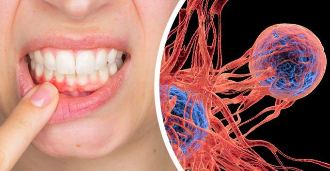 Got Gingivitis? Get Checked For This Deadly Disease