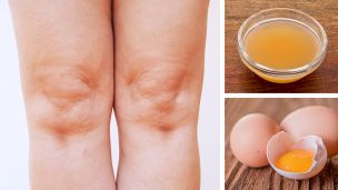 How To Use ACV And Egg Yolks For Knee Pain