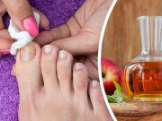 7 Natural Remedies To Banish Toenail Fungus