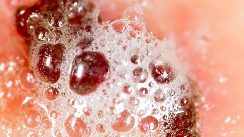 Clean Mold and Wounds with This Must-Have Solution (hint: it’s super cheap)