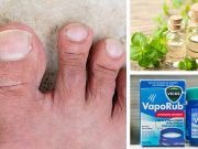 5 Natural Cures For Toenail Fungus You Can Find In Your Pantry