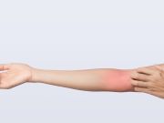 Easy Eczema Fix You Can Make at Home