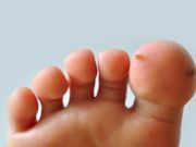 Try These Ways to Get Rid of Warts Fast…Naturally