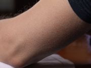 The Solution for the Little Red Bumps on Your Arms