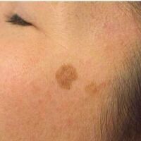 DarkSpot-Face300x600