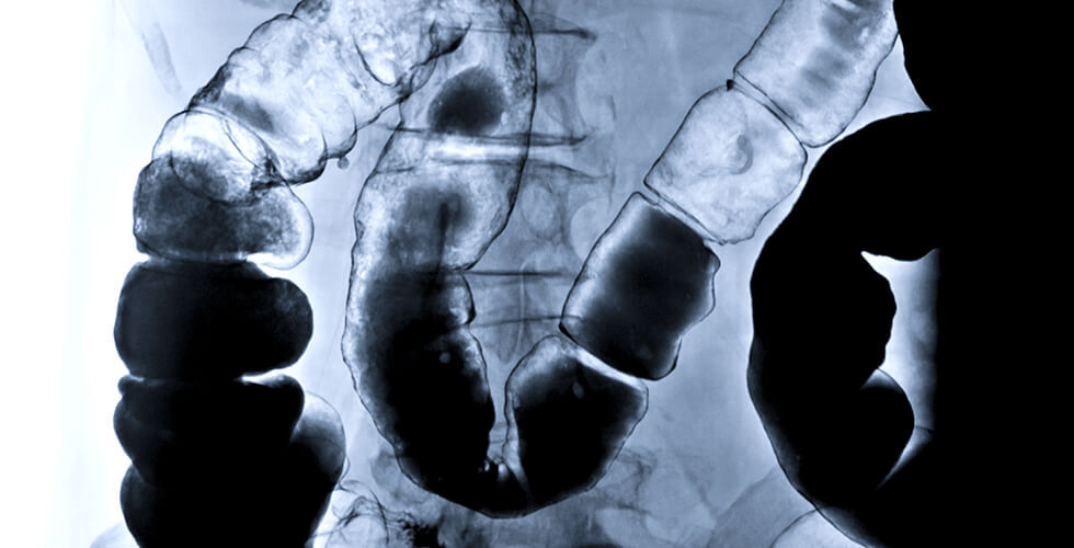 The Hidden Dangers of Sugar, Processed Meat, and Ultraprocessed Foods for Your Colon