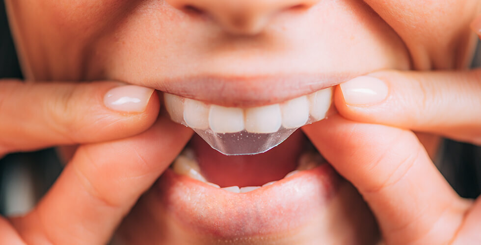 Why You Might Want to Skip Whitening Strips—and What to Try Instead